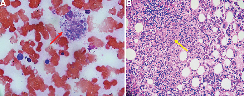 (A) Bone marrow aspirate (PAS, ×40) showing evidence of hemophagocytosis with histiocytes (red arrow) showing intracellular small yeast forms (crescent-shaped nuclei with a pericellular halo) suggestive of histoplasmosis. (B) Bone marrow biopsy (H and E, ×10) showing ill-defined granulomas (yellow arrow) formed by tiny foci of necrosis with karyorrhectic debris and epithelioid histiocytes and lymphocytes.